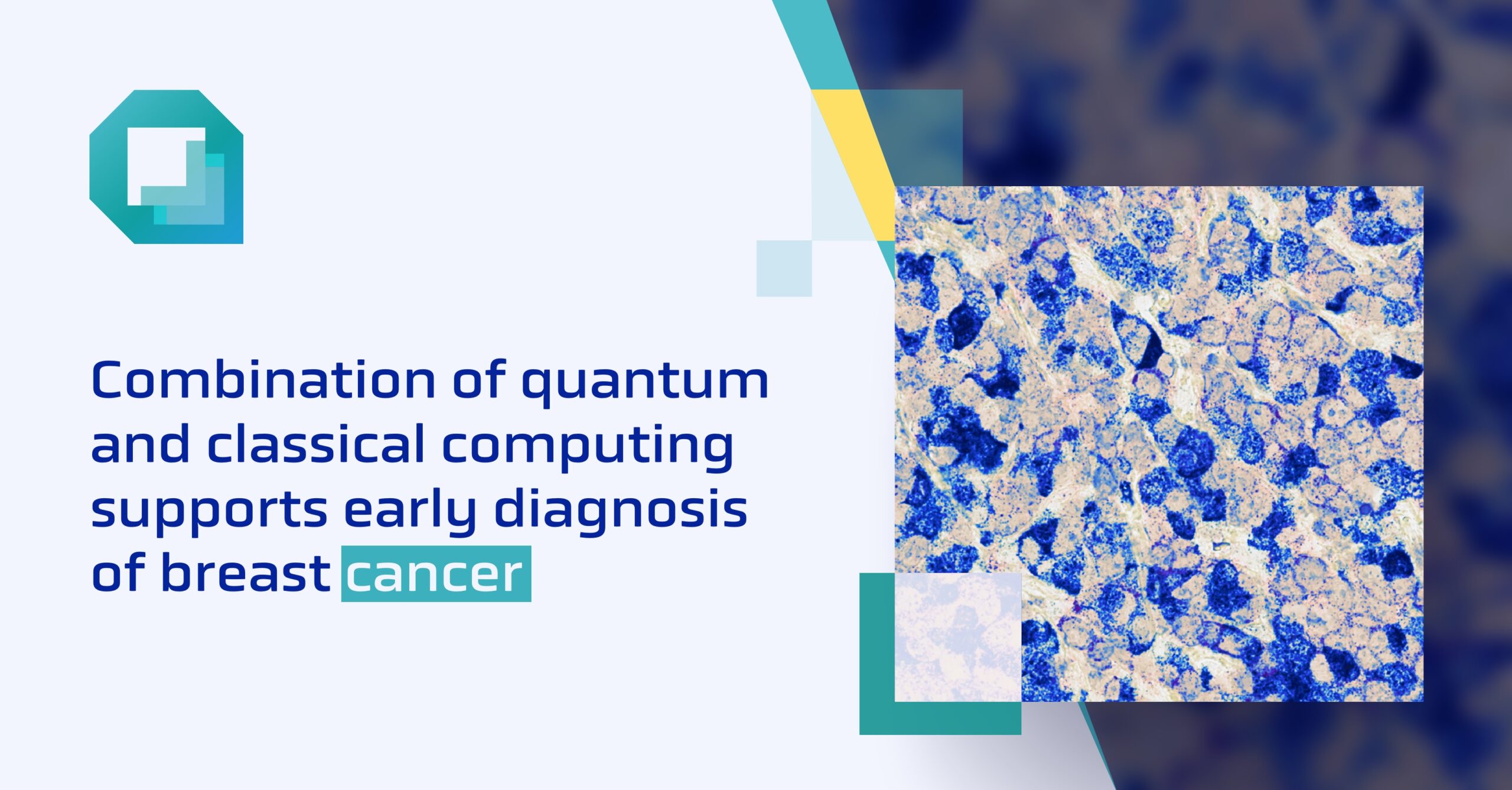 Combination of quantum and classical computing supports early diagnosis of breast cancer